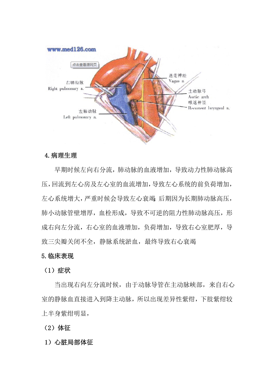 动脉导管未闭图文详细讲解.doc